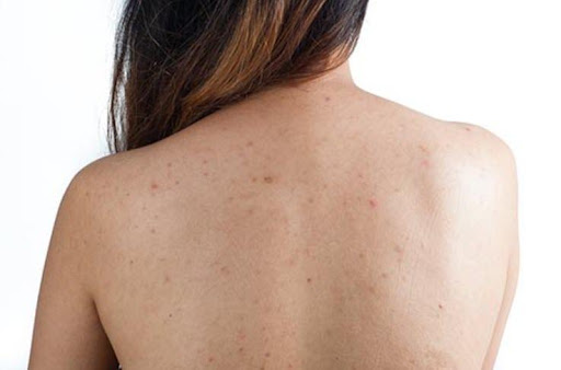 What Should You Do When You Get Acne on Your Back?