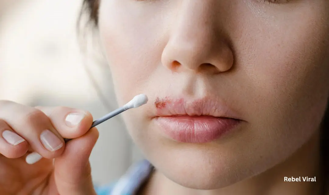 What to Do If You Have Herpes on Lip Outbreak Without Treatment?