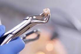 Choosing the Right Dental Clinic for Impacted Surgical Extractions: Factors to Consider